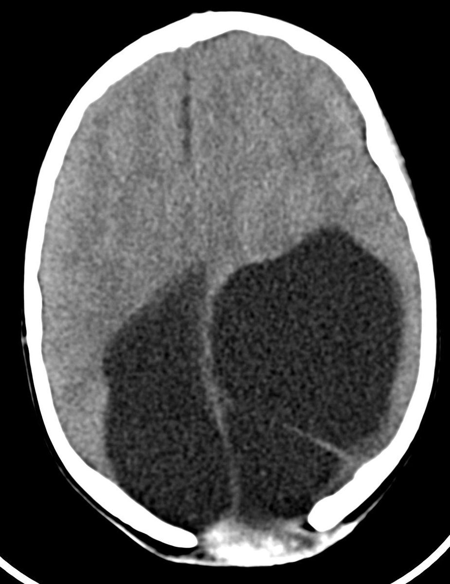 drmankad's tweet photo. Important for the #radiologist to insist on a baseline MRI in kids when presented with odd intracranial cysts being dealt with by #neurosurgery only. Also, many of these cases are brought to the radar of the #geneticist by #radiologists. How do we label what the MRI reveals? https://t.co/aQcPU3CDdj