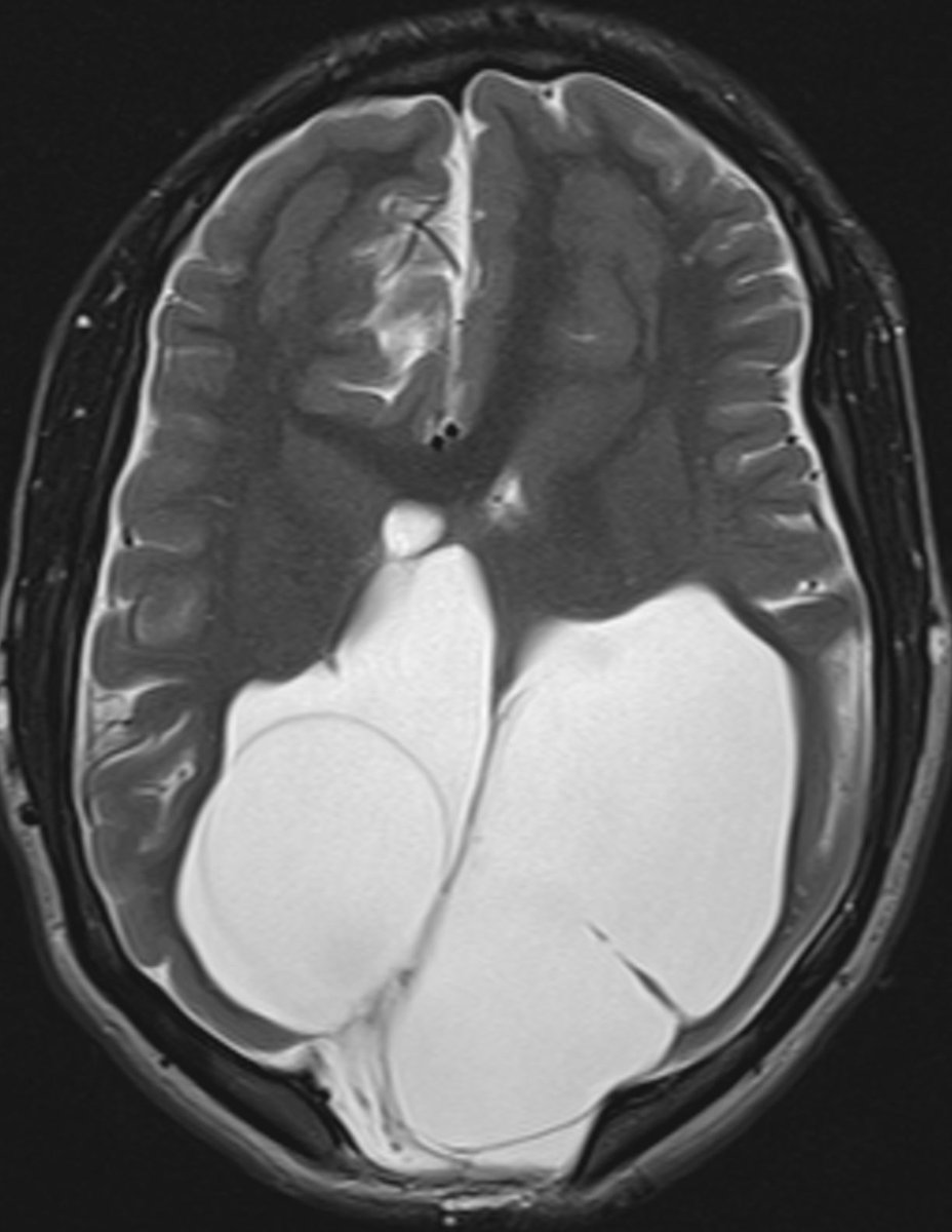 drmankad's tweet photo. Important for the #radiologist to insist on a baseline MRI in kids when presented with odd intracranial cysts being dealt with by #neurosurgery only. Also, many of these cases are brought to the radar of the #geneticist by #radiologists. How do we label what the MRI reveals? https://t.co/aQcPU3CDdj