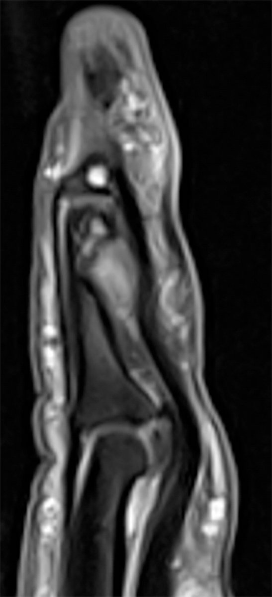 RadioGraphics's tweet photo. This Fundamentals PPT reviews anatomy, imaging techniques, and soft-tissue lesions encountered in the fingers. Improve your understanding and DDx of these difficult cases. #mskrad #orthotwitter https://t.co/hLvNbfhGW6 https://t.co/9uUXYCYe1F