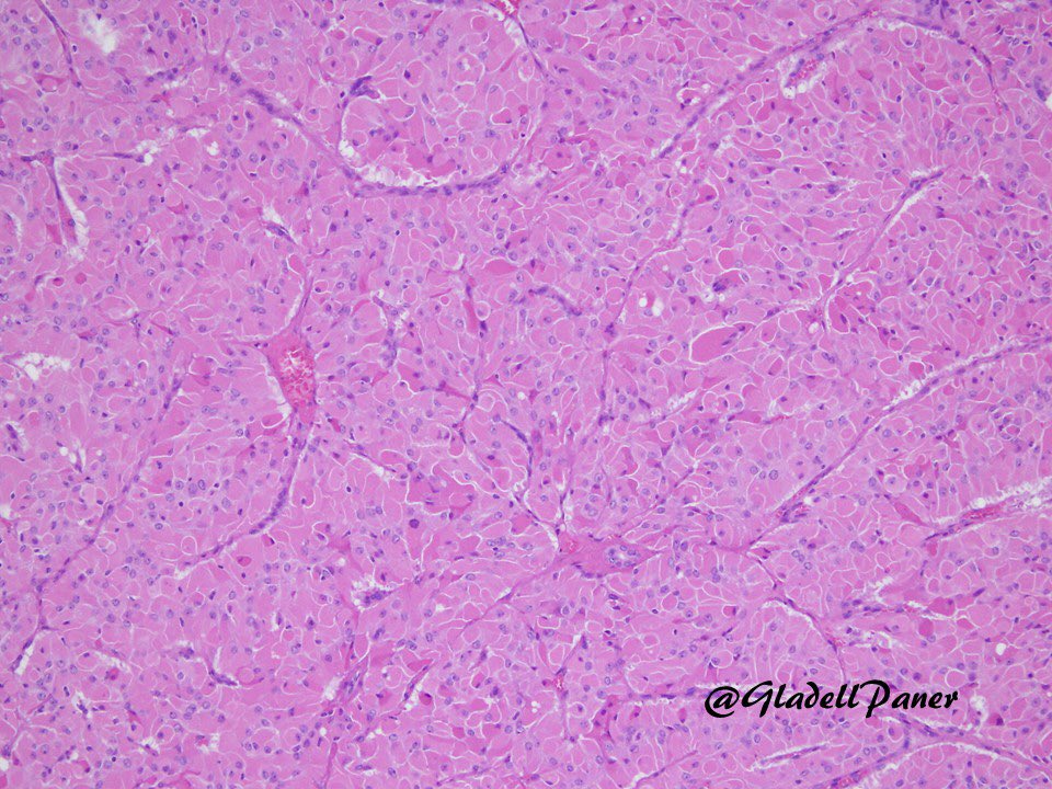 GladellPaner's tweet photo. Beware of this pitfall in a challenging diagnosis! Partial #nephrectomy in an adult for a 3 cm #renal mass.

What is your diagnosis for this oncocytic tumor?

🔬Answer in comment. #GUPath https://t.co/uXZefUYiTC
