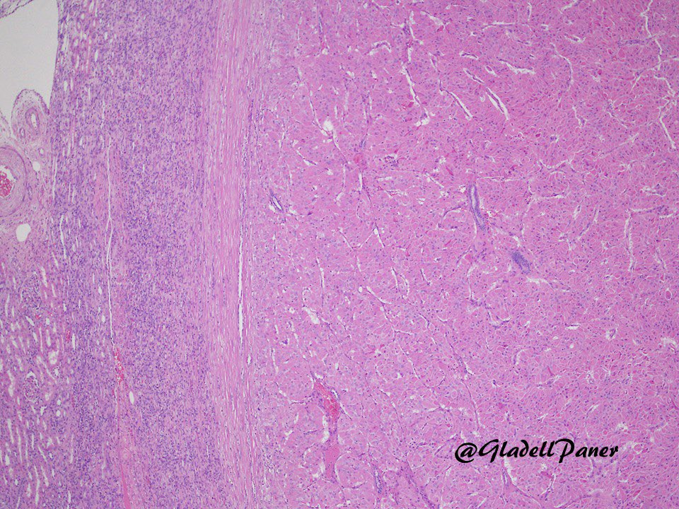 GladellPaner's tweet photo. Beware of this pitfall in a challenging diagnosis! Partial #nephrectomy in an adult for a 3 cm #renal mass.

What is your diagnosis for this oncocytic tumor?

🔬Answer in comment. #GUPath https://t.co/uXZefUYiTC