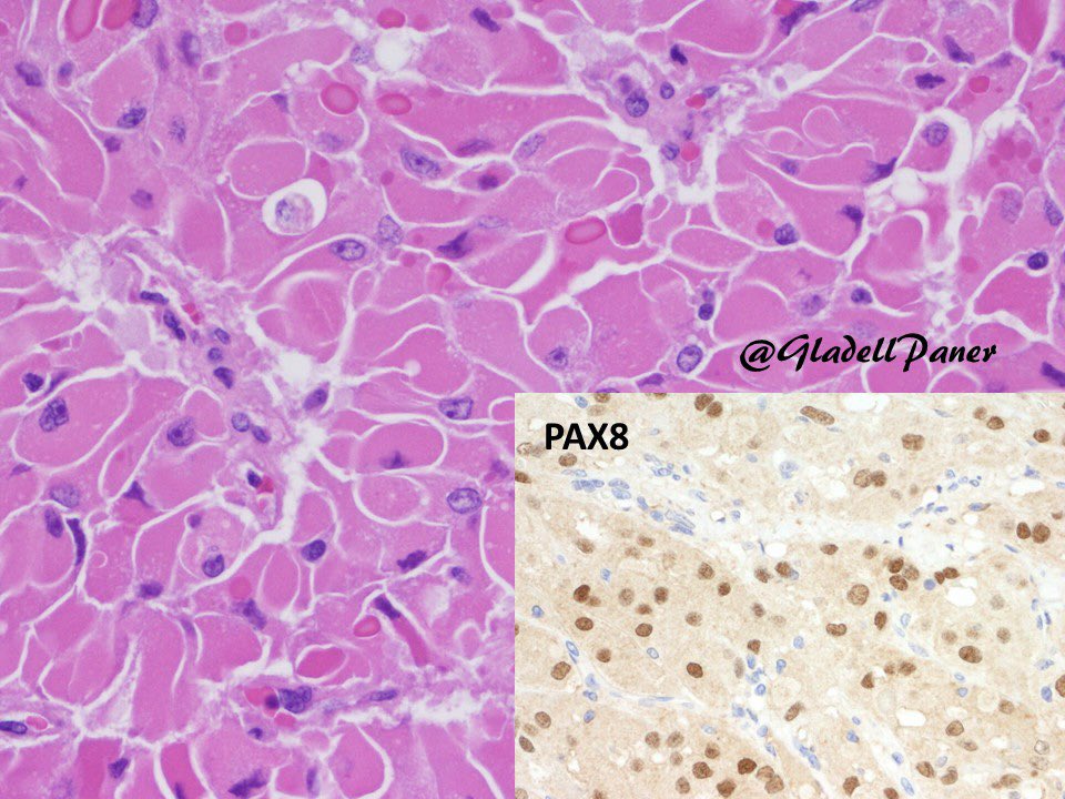 Beware of this pitfall in a challenging diagnosis! Partial #nephrectomy in an adult for a 3 cm #renal mass. What is your diagnosis for this oncocytic tumor? 🔬Answer in comment. #GUPath