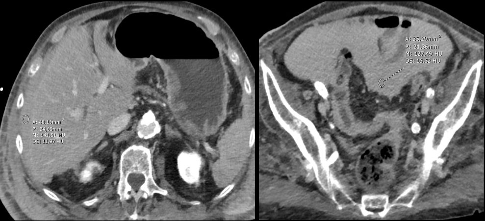 A 🧵about an interesting case of a middle age male with acute cholecystitis and recent placement of SMA stent. Suspected complication. #SpectralCt was performed.

@cookyscan1
@CtSpectral
@EmergTraumaRad
@nicoalmeidaa

#1 What do you see?