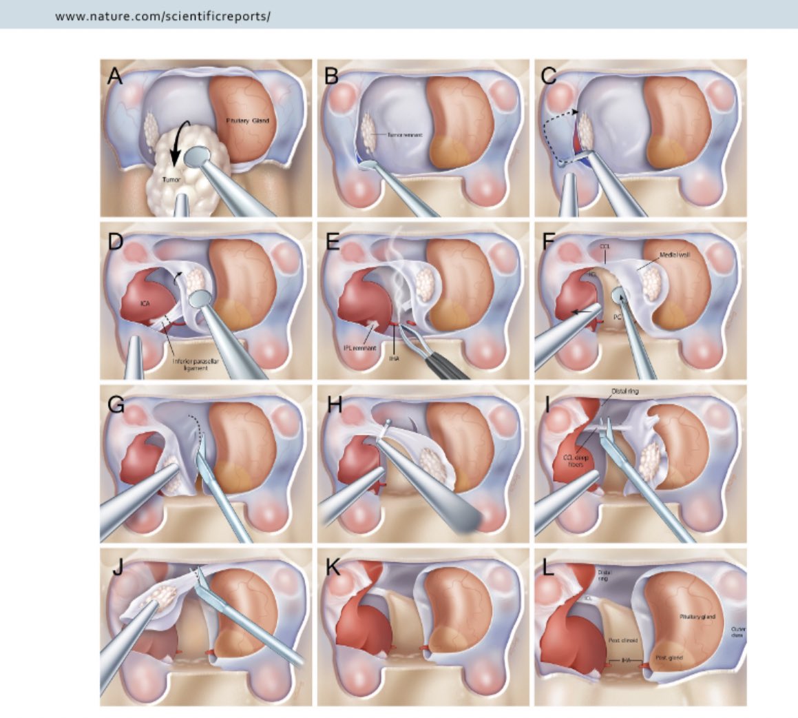 drjfm_stanford's tweet photo. Here our new publication @Nature #scientificreports Surgical innovation brings improved outcomes and new hope for #pituitary #Acromegaly patients @StanfordNsurg @StanfordMed Great collaborative work by @MohyeldinAhmed @KatznelsonLarry @AcroCommunity https://t.co/2jINX5Ui8k https://t.co/rQn30A0JAd