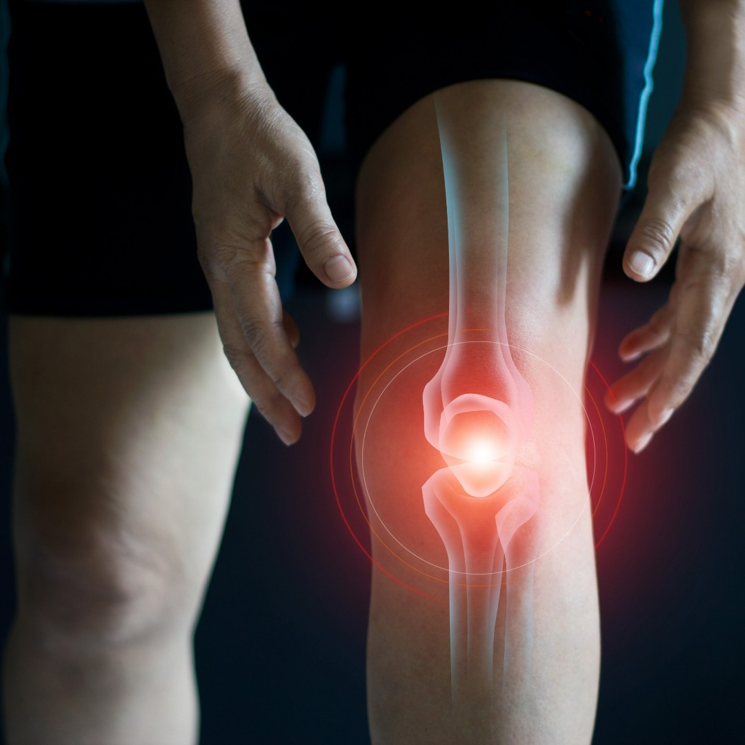 Osteoarthritis of the knee can be extremely painful! If you are living with osteoarthritis, contact ClinCloud today to learn more about a new research study! #arthritis