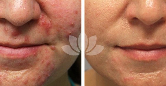 HighlyRatedPros's tweet photo. Stubborn acne treated by Dr. Perez-Quintairos, dermatologist in South Miami, FL. Check more before and after pictures of general dermatology and cosmetic treatments at: https://t.co/2eDNbR1rRZ

#DermatologistSouthMiami #SouthMiami #Dermatologist https://t.co/112Uh1gn3J
