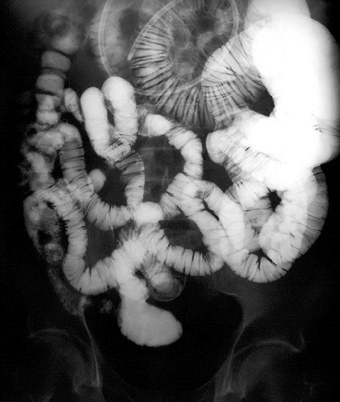 American College of Radiology on Twitter "25 y/o male w/ hemoccult positive stools and neg
