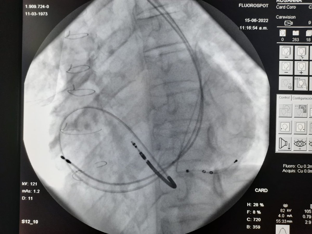 drgonzalovarela's tweet photo. Excelente resultado final.   Servicio de Electrofisiologia Sanatorio Casa de Galicia https://t.co/m2eD6RNKxF