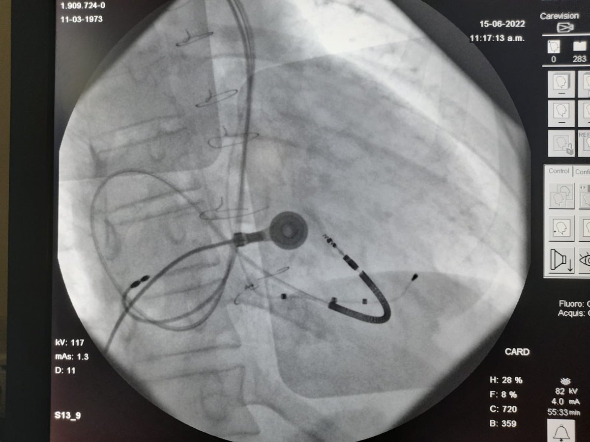 drgonzalovarela's tweet photo. Excelente resultado final.   Servicio de Electrofisiologia Sanatorio Casa de Galicia https://t.co/m2eD6RNKxF