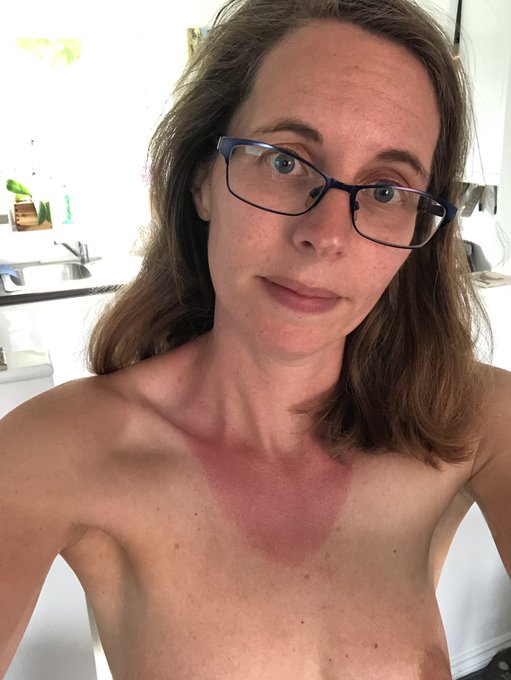 Oh dear! Just as I&rsquo;m about to head out to a #nudie open evening at a local garden, I realise I should<a href="/tag/nudie"class="tags">#nudie</a><a href="/tag/sunburn"class="tags"><span>#sunburn</span></a><a href="/tag/pickleball"class="tags"><span>#pickleball</span></a>