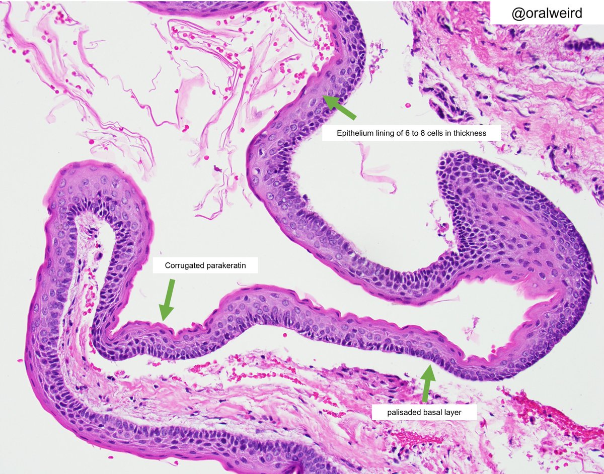 📸of the day~ Odontogenic keratocyst🐍
#pathology #pathologist #headandneck #PathTwitter #picoftheday #oralpath