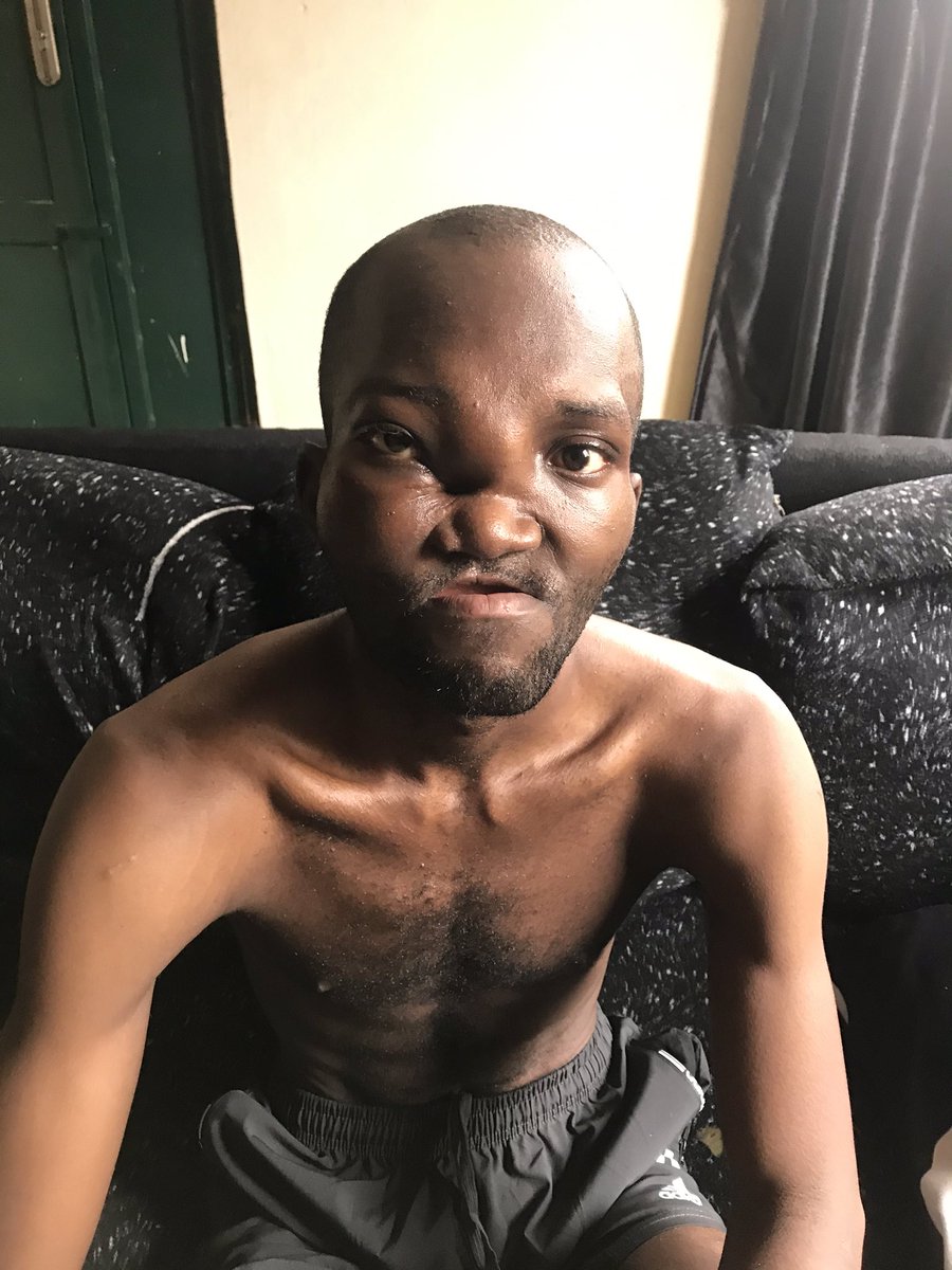 IwerCedrick's tweet photo. my name is Iwer Cedrick Torkuma, I have been battling jaw cancer(Osteosarcoma) for two years, I have undergone three surgeries, my whole jaw was removed from the last one. I have also undergone Radio and chemotherapy but the tumor still came back in between my eyes and  neck. https://t.co/UnIXaRohXj