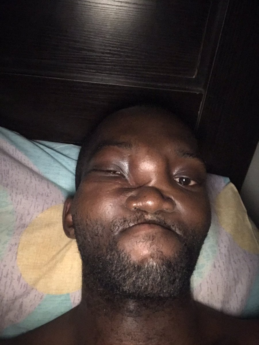 IwerCedrick's tweet photo. my name is Iwer Cedrick Torkuma, I have been battling jaw cancer(Osteosarcoma) for two years, I have undergone three surgeries, my whole jaw was removed from the last one. I have also undergone Radio and chemotherapy but the tumor still came back in between my eyes and  neck. https://t.co/UnIXaRohXj