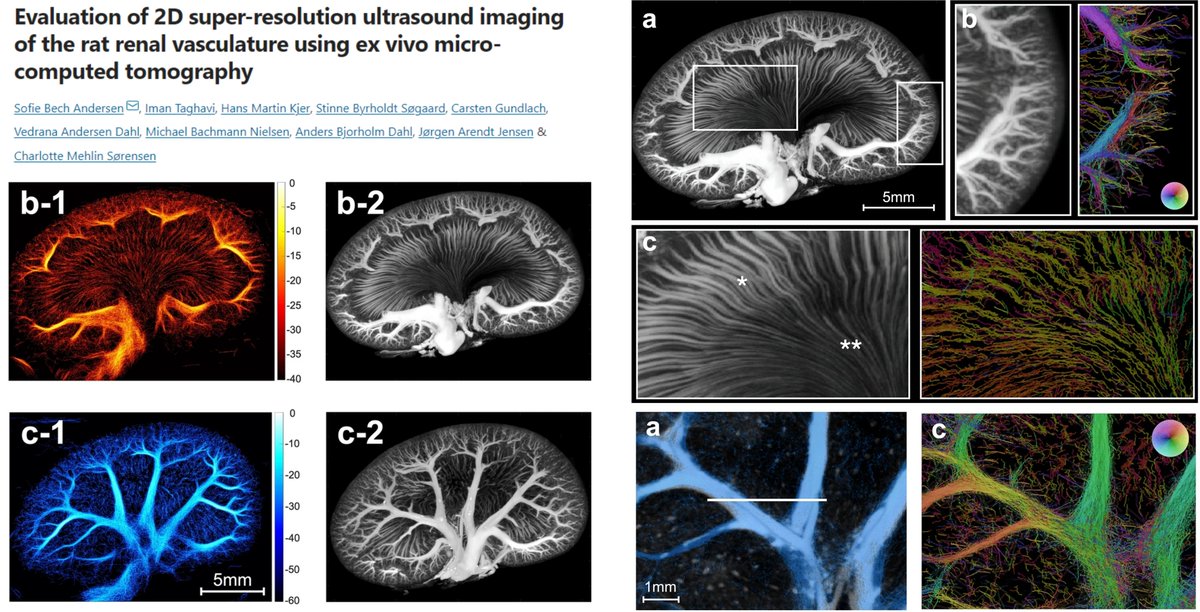 HaoYin20's tweet photo. Co-registering #SuperResolutionUltrasoundImaging #SRUS in vivo & μCT ex vivo
Rat renal vascular tree φ 100-1300 μm🤩
Like 2nd last paragraph in Discussion-Push the limit for #VasaRecta φ 20 μm
Dr. Sofie Bech Andersen lab @SciReports 2022 @CharlotteMehlin
https://t.co/6v3UGG5Xk5 https://t.co/llcAkPGHVr