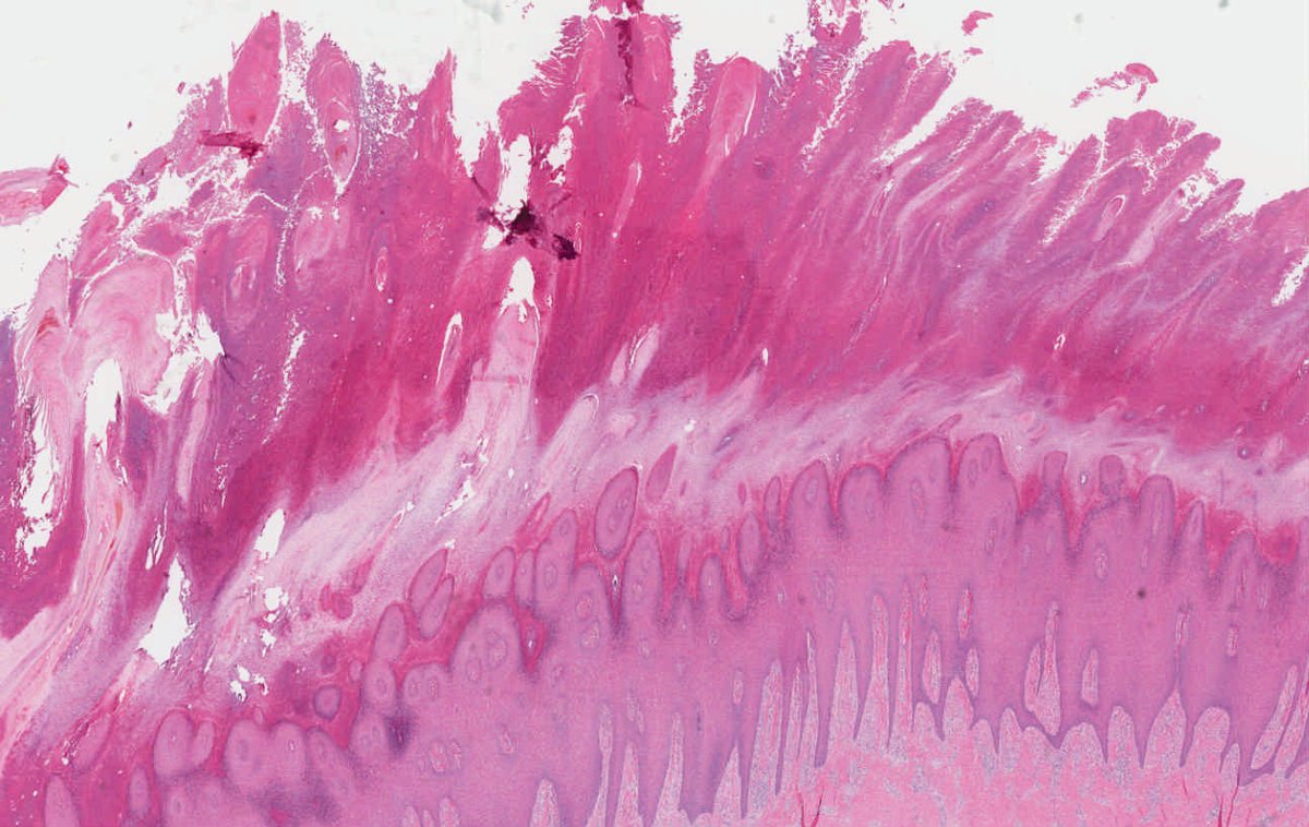 McGill Pathology Residents 🔬 (@mcgillpathres) on Twitter photo A case of a 49M with a wound on the left heel from our rotating MS3 Kathleen D'Aguanno! More images and Dx 👇👇 <a href="/VHNguyenMD/">Van-Hung Nguyen MD 🇺🇦🌻</a> <a href="/SimonRoyMD/">Simon Roy MD</a> #dermpath #pathelective A case of a 49M with a wound on the left heel from our rotating MS3 Kathleen D'Aguanno! More images and Dx 👇👇 <a href="/VHNguyenMD/">Van-Hung Nguyen MD 🇺🇦🌻</a> <a href="/SimonRoyMD/">Simon Roy MD</a> #dermpath #pathelective