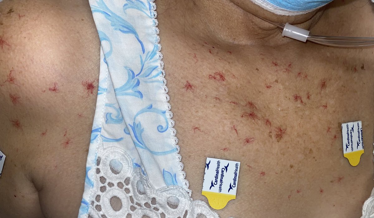 I admitted a patient last night with this pathognomonic feature across her body. 

I was sad I didn’t have a med student with me who I could show and teach to, so putting it out here for #MedTwitter 

For all the medstudents and incoming interns, what’re your differentials⁉️