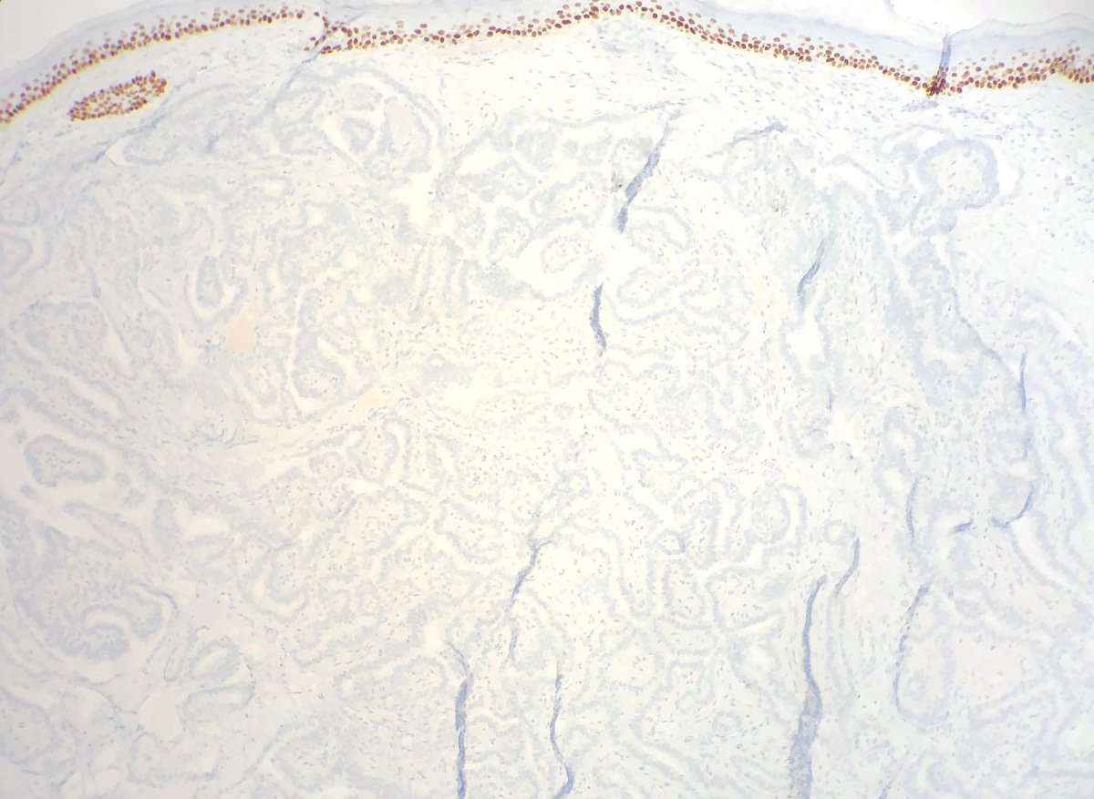 Daniel Skipper (@dcskipperdo) on Twitter photo <a href="/mccalmo/">Tim McCalmont</a> <a href="/HENRYY_MD/">Henry YANG</a> <a href="/david_terrano/">David Terrano</a> <a href="/et565/">Etan Marks, DO</a> <a href="/alegru18/">Alejandro Gru (Ale)</a> <a href="/ChristineJKoMD/">Christine J. Ko, MD</a> <a href="/PIorfino/">Dermpath_doc_trish</a> <a href="/SGottesmanMD/">Silvija Gottesman MD</a> <a href="/Dermpathl/">Dermpath-L</a> <a href="/MarcelaSaebL/">Marcelasaeblima.</a> #ihcpath CK7, TTF1, PAX8, p63. Not such a long shot in this case <a href="/mccalmo/">Tim McCalmont</a> :-). <a href="/david_terrano/">David Terrano</a> you nailed it! <a href="/mccalmo/">Tim McCalmont</a> <a href="/HENRYY_MD/">Henry YANG</a> <a href="/david_terrano/">David Terrano</a> <a href="/et565/">Etan Marks, DO</a> <a href="/alegru18/">Alejandro Gru (Ale)</a> <a href="/ChristineJKoMD/">Christine J. Ko, MD</a> <a href="/PIorfino/">Dermpath_doc_trish</a> <a href="/SGottesmanMD/">Silvija Gottesman MD</a> <a href="/Dermpathl/">Dermpath-L</a> <a href="/MarcelaSaebL/">Marcelasaeblima.</a> #ihcpath CK7, TTF1, PAX8, p63. Not such a long shot in this case <a href="/mccalmo/">Tim McCalmont</a> :-). <a href="/david_terrano/">David Terrano</a> you nailed it!