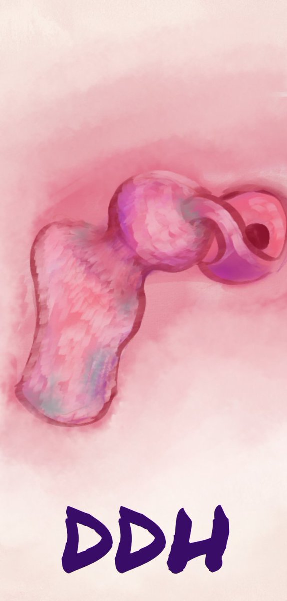 childortho's tweet photo. #HipHealthAwareness via #Art !
Early detection and treatment of #DDH is of prime importance for a great result. This is important to avoid the long term issues of #HipDysplasia
Suspect | Screen | Treat | Advocate
#Art #painting
#ChildsHip
#HipDysplasia
#ArztForACause https://t.co/Y2wbxnkRmm