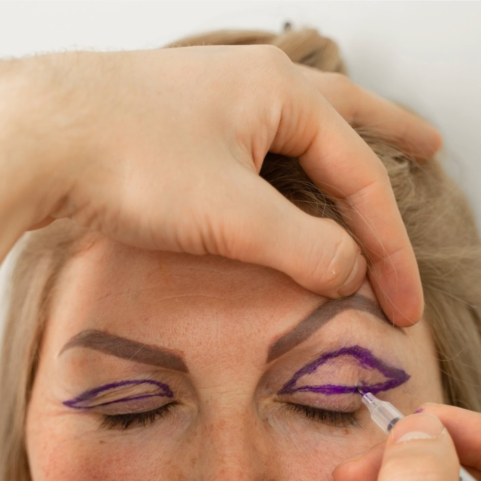 drhellers's tweet image. The most important part in upper eyelid 👁 surgery (blepharoplasty).

The planing of an operation is an important step for success. Blepharoplasty may involve removing excess skin, muscle and fat. This is not a painful procedure and recovery is relatively easy. In an awake...