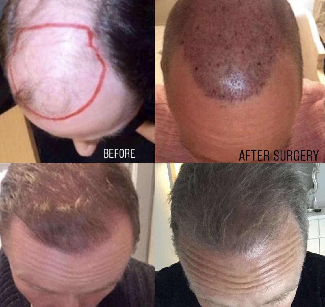 surgerygroup.co.uk/patient-storie… Read about Michael’s hair restoration journey with Surgery Group