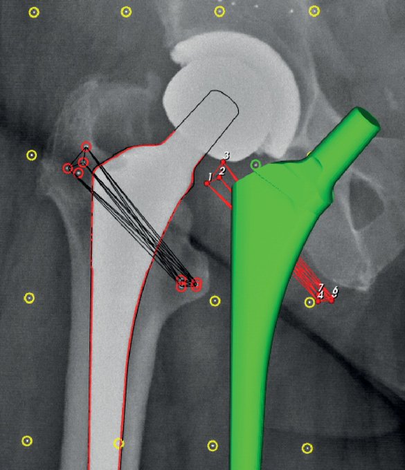 WalkerRo2's tweet photo. This efficacy trial investigated the effect of an electrochemically applied hydroxyapatite coating on the migration of porous titanium plasma-sprayed cementless stems up to five years’ follow-up.

#arthroplasty #ortho

https://t.co/4PWKxXU3gl https://t.co/EXjYU7OAHv