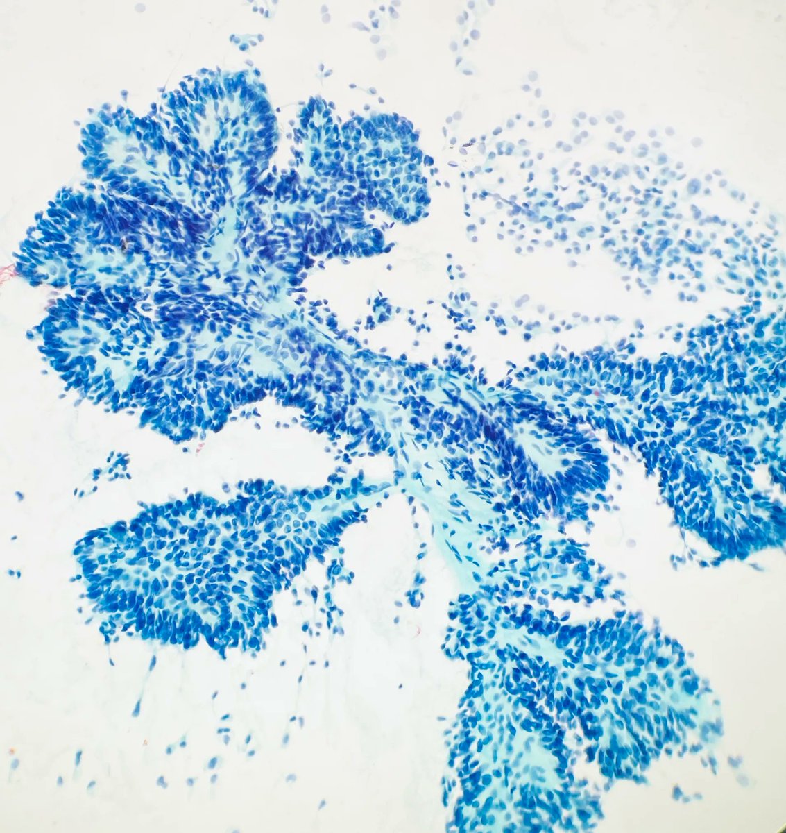 Fine needle aspiration of a thyroid nodule revealing arborizing papillae of tumor cells. What is the diagnosis? Answer: kikoxp.com/posts/11784 #PathArt #CytoPath #PathTwitter #MedTwitter #Cytology