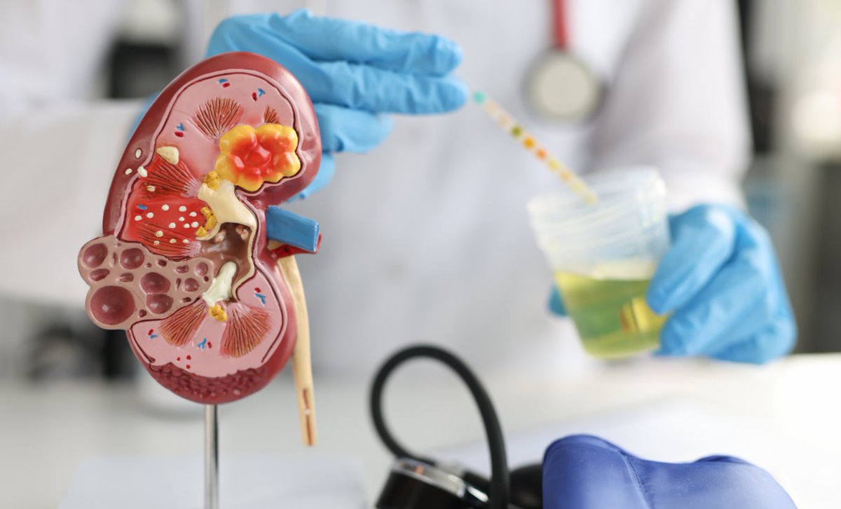farmaceuticsbcn's tweet photo. 🗓️Avui és el #DiaMundialdelCàncerRenal. 
Recentment en vam parlar de les novetats en el diagnòstic i el tractament d'aquest càncer, en l’àmbit de la farmàcia hospitalària, en el marc d'una formació organitzada conjuntament amb @SCFarmClin. 
➡️https://t.co/EUFfvsYpcW https://t.co/jKiJMQOO73