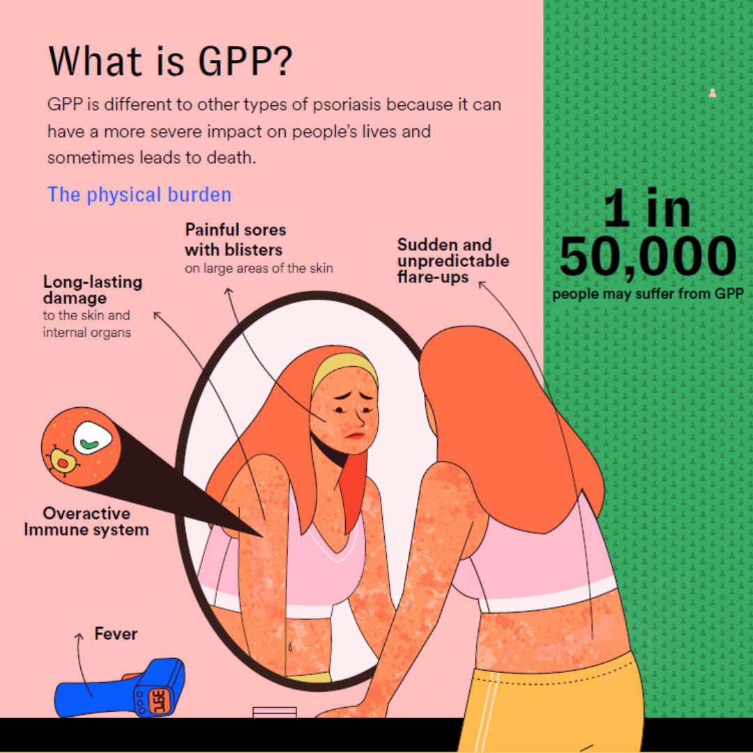 PsoriasisIFPA's tweet image. GPP. 1 in 50,000 people live with this painful, unpredictable form of #psoriasis. A new study published by IFPA, @Europso_org and clinical experts makes the case for rare and orphan disease designation to combat its particular unmet needs. #rareismany
ow.ly/CMz150JvQjf