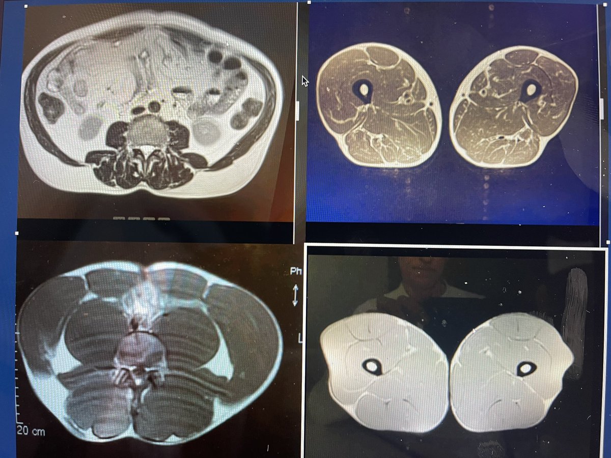 DrSeanOMara's tweet photo. An MRI of her leg and and abdomen would be an undeniable refutation of her life harming if not deadly misconception. Top scan diseased belly & legs Bottom: healthy belly & legs. MRI don’t Lie! . #visceralfat #fattyinfiltrates #doc2alphas https://t.co/jsm6HKuEQ5