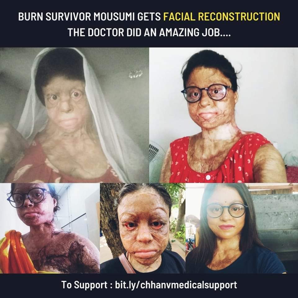 StopAcidAttacks's tweet photo. #ReconstructionSurgery #BurnSurvivor
Mousumi is a burned survivor, she has gone with 8 reconstructive surgeries till now and the improvement can be seen in the image. The incident took place on 01/08/2019.
She needs help as she has ran out of finances for medical treatment. https://t.co/rhdJkvR79P