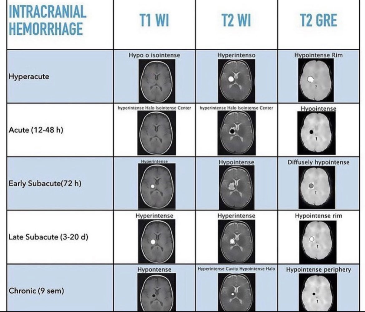 OGdukeneurosurg's tweet photo. Be the doc who can confidently state the age of an intraparenchymal bleed on MRI using the info in this chart. https://t.co/SrqamrUZ5r
