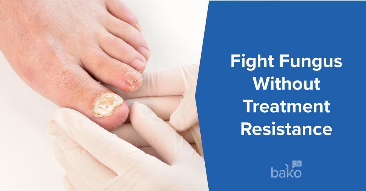 CTPodiatrists's tweet photo. If you suspect onychomycosis, obtain laboratory confirmation that the dermatophyte is not resistant to terbinafine prior to initiating therapy. To learn more, visit https://t.co/5AwMxT70v1.
#terbinafineresistance #onychomycosis #PCR #podiatrist #CTPMA #BakoDx https://t.co/BLXByxjytR