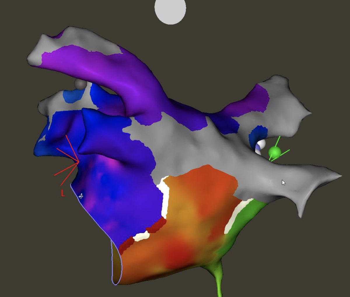 Vein of Marshall (VOM) EtOH tx really makes lateral mitral block so much easier.  And likely reduces triggers by effectively ablating anterior ridge and VOM-associated ganglionic plexi.  Acute ICE changes are impressive. #EPeeps
