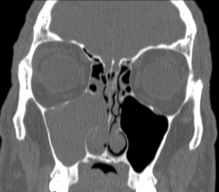 DrScottFortune's tweet photo. 1/2: Right Maxillary Sinus Inverting Papilloma referred after first operation. Preop CT scans #Maxillary #InvertingPapilloma #Rhinology https://t.co/yzNUjsO6Bt