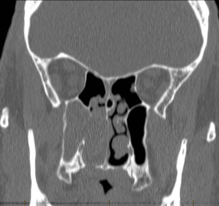 DrScottFortune's tweet photo. 1/2: Right Maxillary Sinus Inverting Papilloma referred after first operation. Preop CT scans #Maxillary #InvertingPapilloma #Rhinology https://t.co/yzNUjsO6Bt