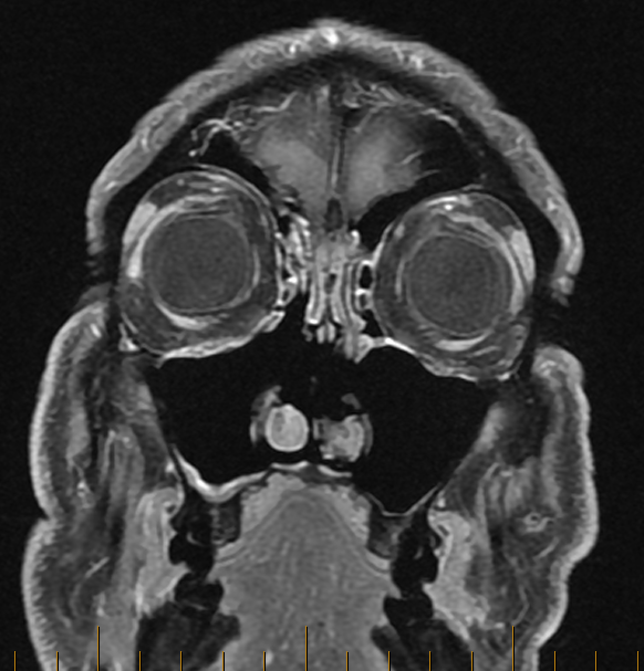 DrScottFortune's tweet photo. 2/2: MRI I obtained after first operation and current endoscopic appearance. Management? #Maxillary #InvertingPapilloma #Rhinology https://t.co/CCx7nF3L5V
