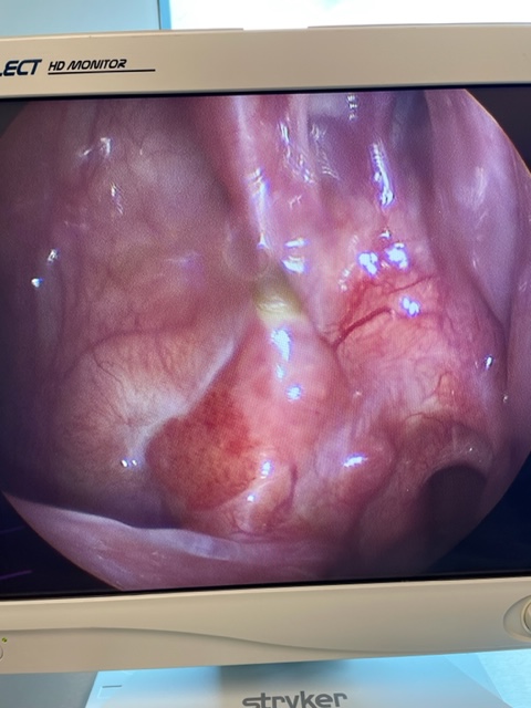 DrScottFortune's tweet photo. 2/2: MRI I obtained after first operation and current endoscopic appearance. Management? #Maxillary #InvertingPapilloma #Rhinology https://t.co/CCx7nF3L5V