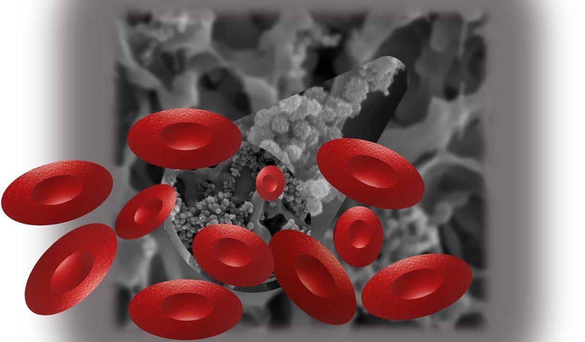 Nicolaus Copernicus University in Toruñ has designed & investigated a new composite material for blood-related applications. They used the Henniker #HPT100 plasma to perform #surfacemodification Read our full knowledge article here sciencedirect.com/science/articl… #plasma #biomaterials