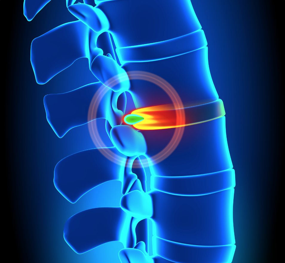 drcorenman's tweet photo. Spine Fact of the Day!
About 95% of the time when a disc herniation occurs, the herniation will occur in this posterolateral position and compress the nerve in the canal. https://t.co/yptGU8LooW #herniateddisc #neckandback https://t.co/EPOXC3XCzs