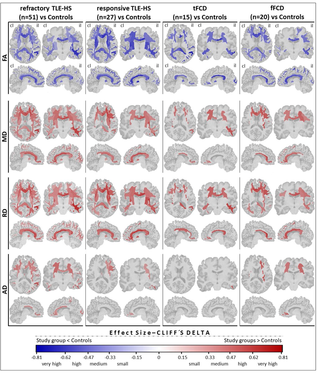 EpilepsiaJourn's tweet image. Superficial and deep white matter diffusion abnormalities in focal epilepsies onlinelibrary.wiley.com/doi/abs/10.111… 
#FrontalLobeEpilepsy #TemporalLobeEpilepsy #DiffusionTensorImaging #Focalcorticaldysplasia #SuperficialWhiteMatter #epilepsy #epilepsyresearch @IlaeWeb @WileyNeuro @yesILAE