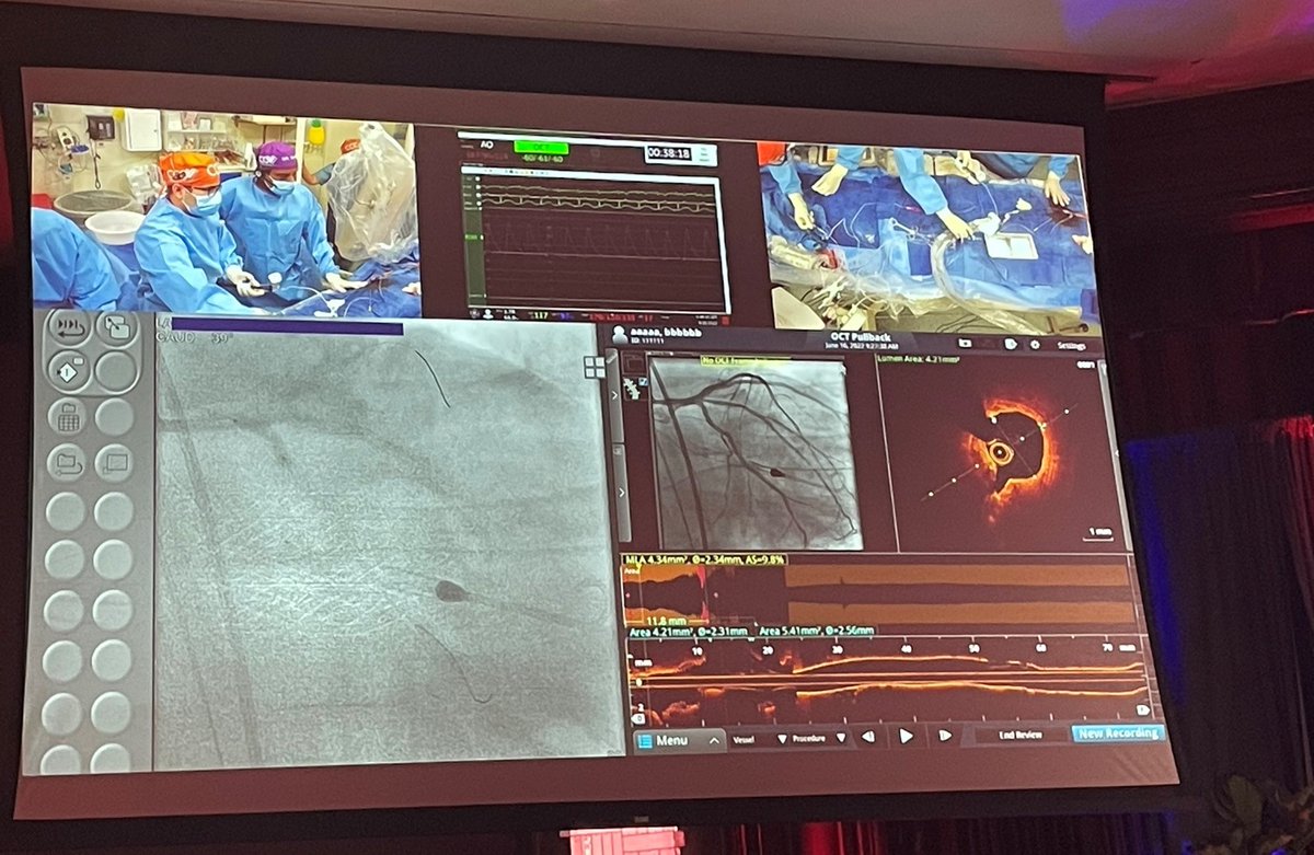 ShockwaveIVL's tweet image. Complex Coronary Live Cases have begun at @CCCSymposium_NY! Congrats to Dr. Samin Sharma for successfully combining #RotaCut AND #RotaShock strategies in a bifurcation lesion with nodular calcium. A great example of complimentary use of Ca mod devices. ISI bit.ly/3iEq7fC