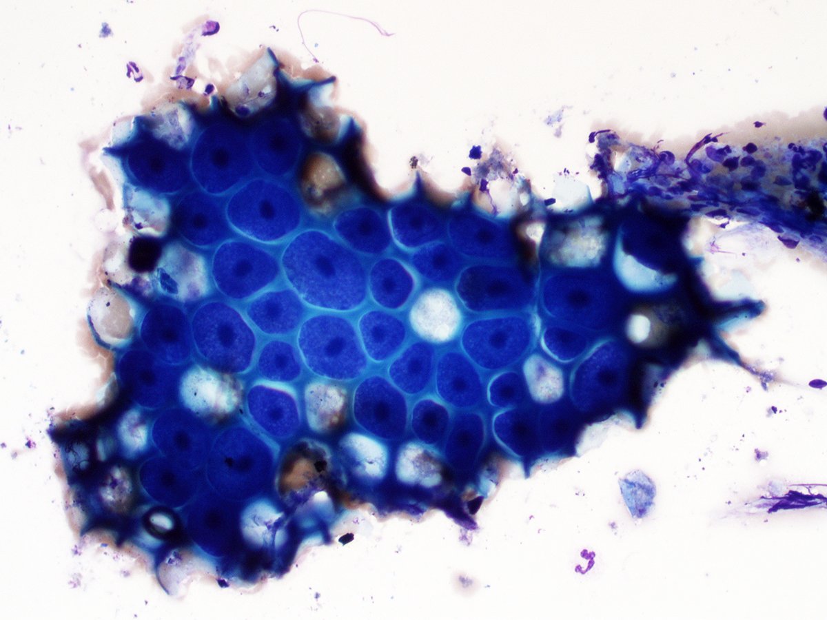 gcai1978's tweet image. 50/M with a 3-cm right thyroid nodule (TI-RADS 5). In addition to the cytology findings consistent with follicular neoplasm, one of direct smears shows a single cluster of atypical cells as shown in this image. How would you like to interpret these cells? #cytology #thyroid #fna