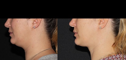 drmcopeland's tweet photo. Patient before and 5 months after neck lipectomy.
Liposuction can be used to help eliminate fat under the chin and is virtually scarless. Neck lipectomy makes a dramatic difference by contouring the jawline. #necklipectomy #neckliposuction #cosmeticsurgerynyc https://t.co/K3LGtbVL1Y