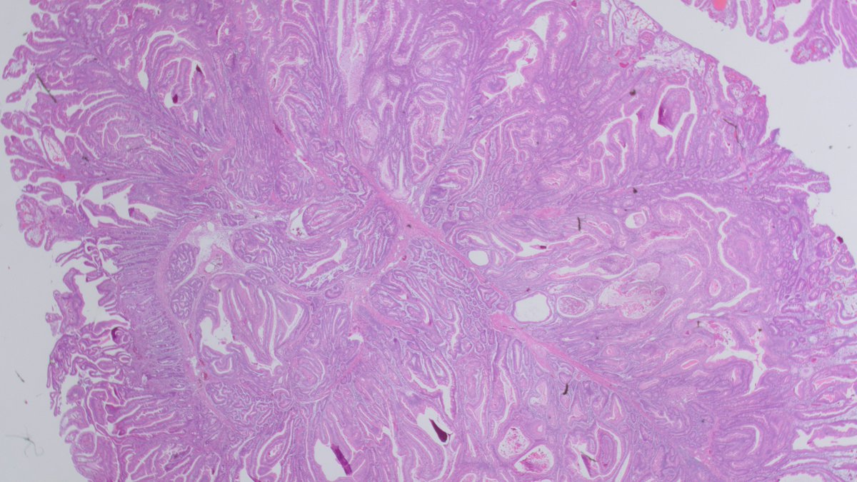 Hamartomatous Polyp, Peutz-Jeghers polyp, papillary architecture, arborizing/branching smooth muscle bundles, STK11 #GIpath #PathTwitter #pathology #Pathboards #GIPS #pathologists <a href="/FLPathologists/">Florida Society of Pathologists</a> <a href="/Pathologists/">CAPathologists</a> <a href="/ASCP_Chicago/">ASCP</a> #pathresidents
