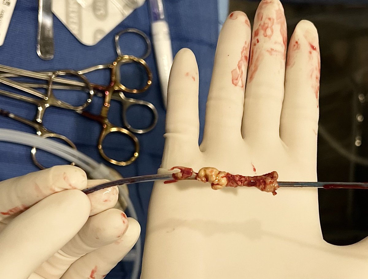 Just a quick extraction you say. The lead is just a year you old you say. 😬