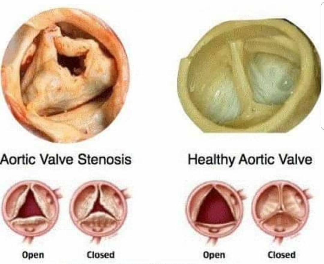 on Twitter "Aortic valve stenosis occurs when the