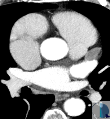 Hey there! Let´s get some #YesSpectralCCT for this friday at <a href="/RMyTC_Rosario/">RM y TC Rosario</a>. This is the case of a 53yo patient who underwent a body CT for follow-up of colon cancer and unknown atrial fibrillation. The study was unremarkable, except for this finding. 
1/8