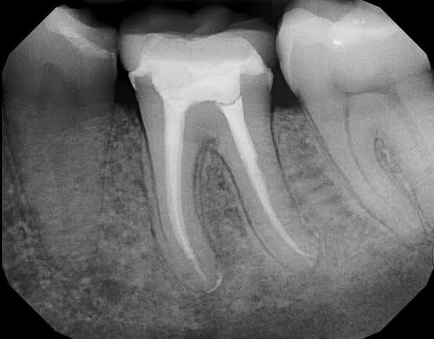 OMDENTALCLINICS's tweet photo. We are specialised for single visit root canal treatment and implant ..For more info visit...https://t.co/cQN9xlDCxL https://t.co/YOazwBdgkf
