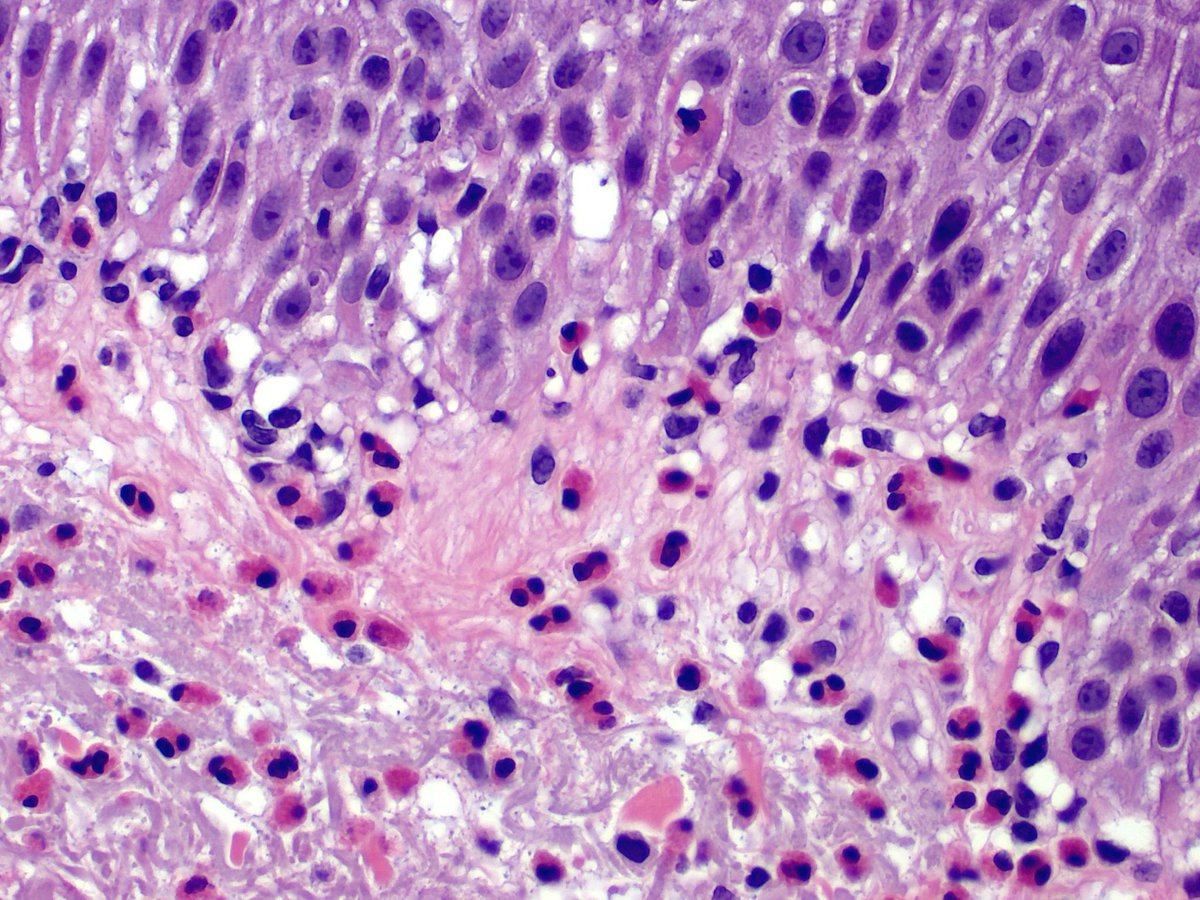 Eosinophilic spongiosis with eos tagging the basal layer in old skin is a good clue to pre-bullous BP.  Scabies and allergic contact are two good DDx; both often have more superficial changes (parakeratosis, serum....mites if you are lucky!).  #dermpath #pathology #dermatology