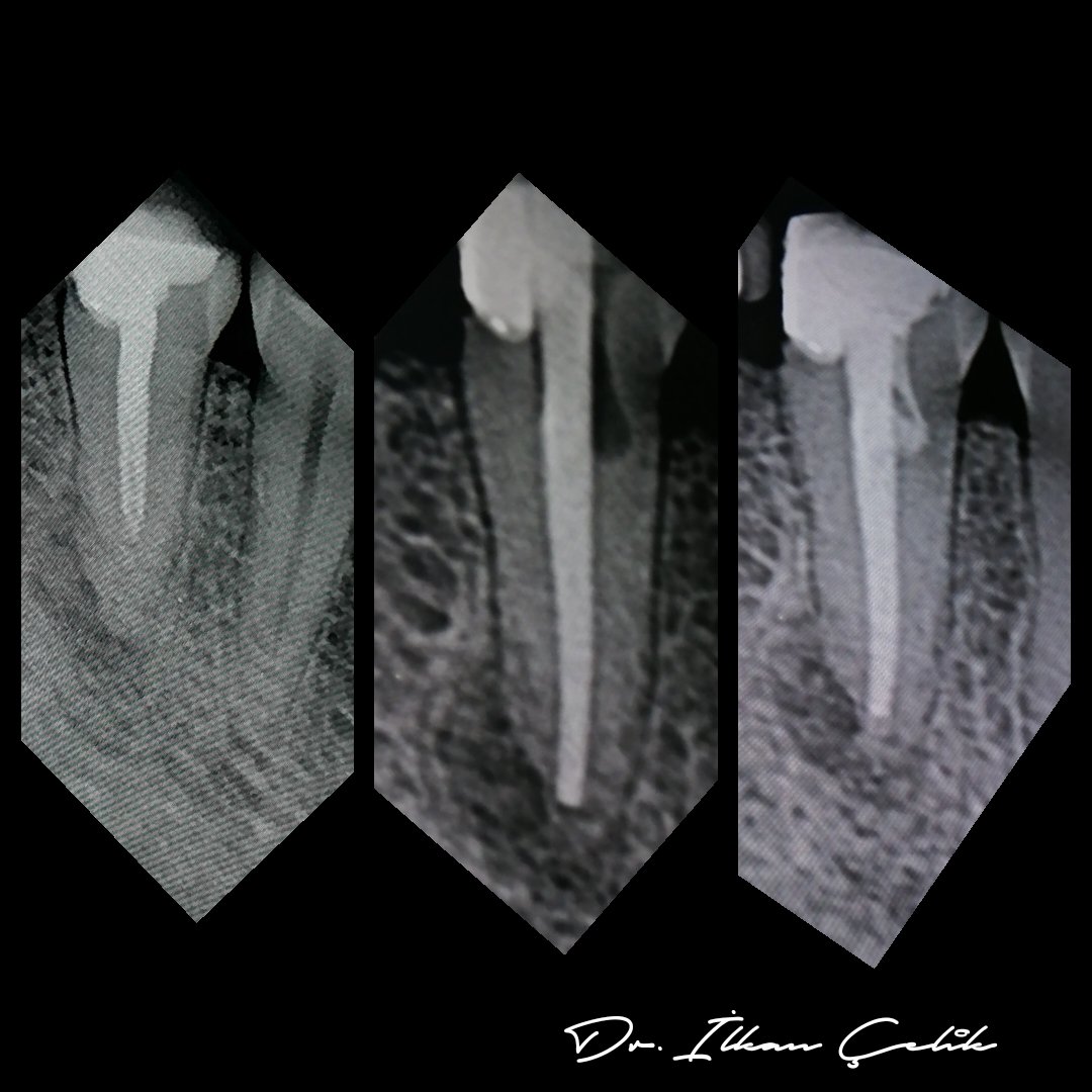 Tekrar Kanal Tedavisi (Retreatment) Vakası
#rootcanalfilling #rootcanalproblems #rootcanalspecialist #rootcanalpreparation #endodontictreatment #endodonticspecialist #endodontia #endodonti #endodontist #endolovers #dentistry #dentistrylife #dentist #doctor #specialistdoctor